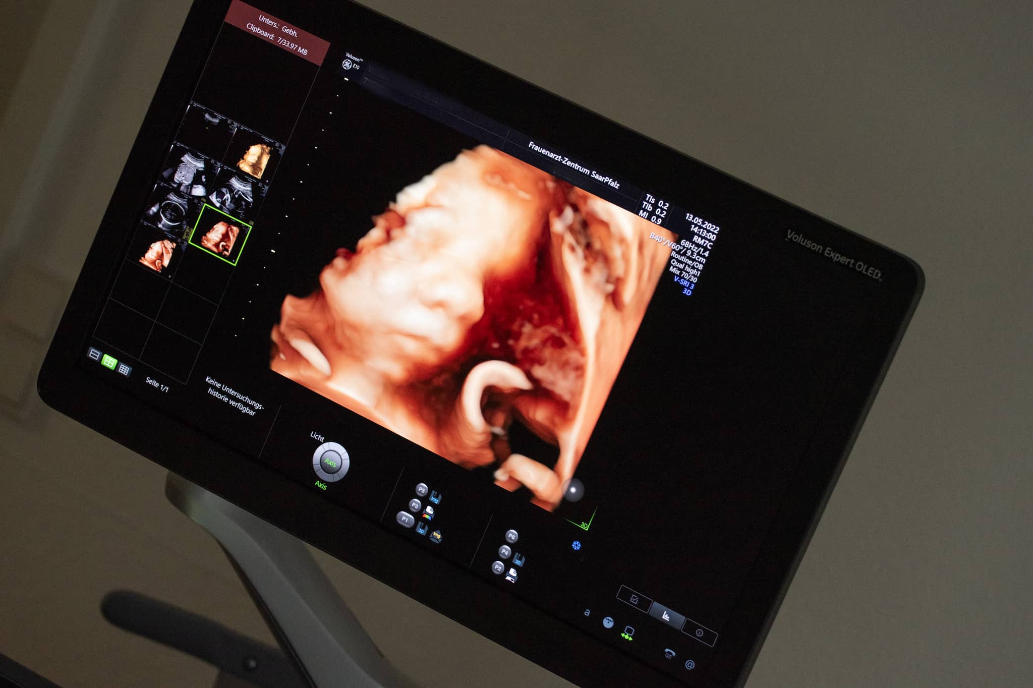 3D Ultraschallbild eines Babys